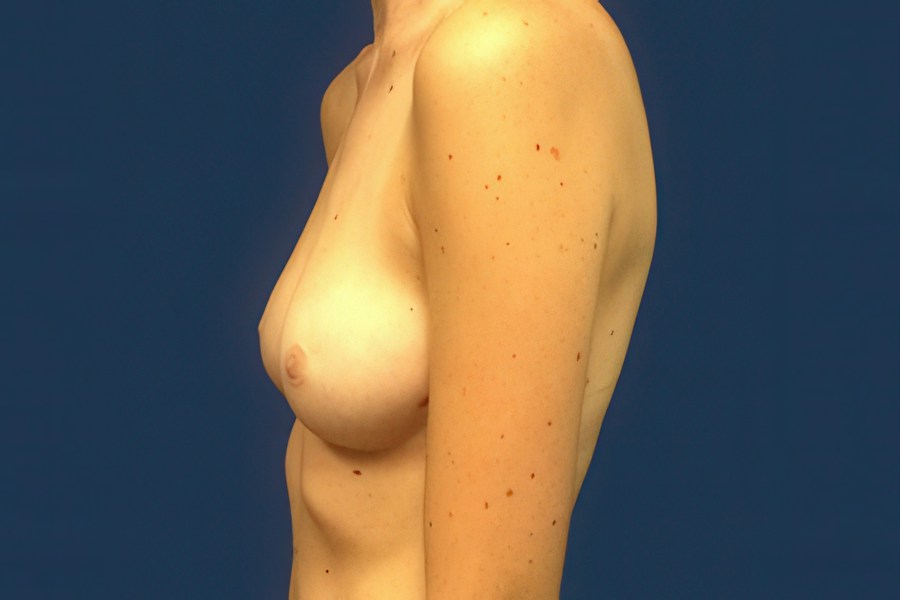 Patient 46678 | Profile View | Before — Dr. Tommaso Addona -
