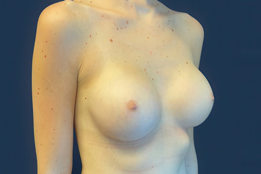 Patient 46678 | Angle View | After — Dr. Tommaso Addona -
