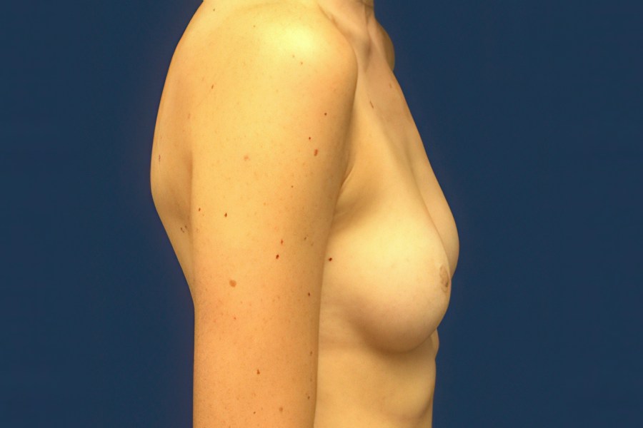Patient 46678 | Profile View | Before — Dr. Tommaso Addona -