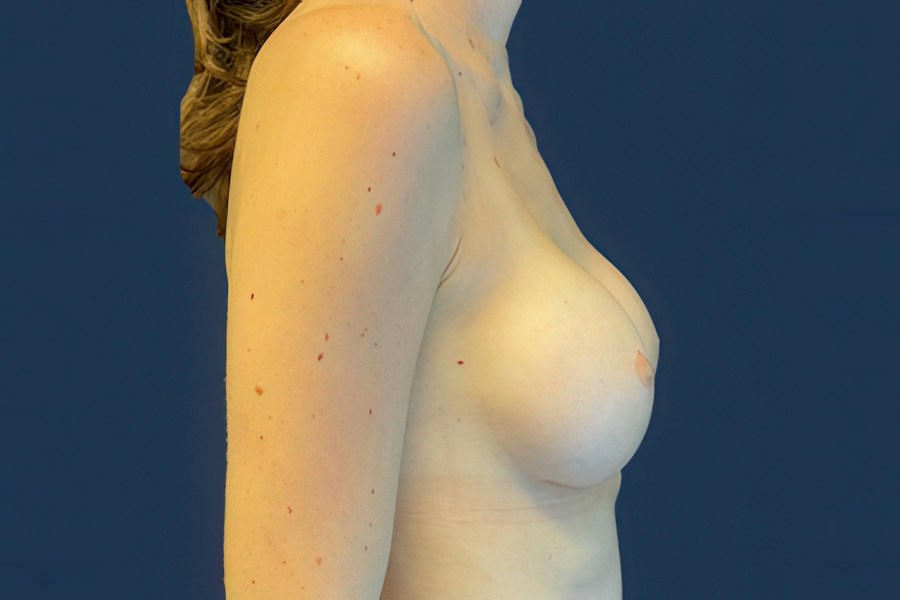 Patient 46678 | Profile View | After — Dr. Tommaso Addona -