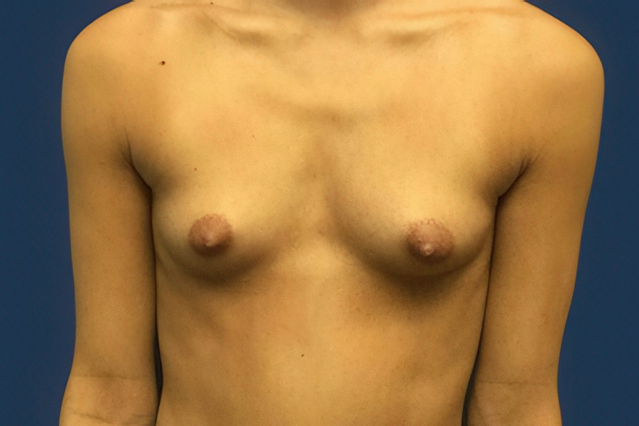 Patient 46677 | Front View | Before — Dr. Tommaso Addona -