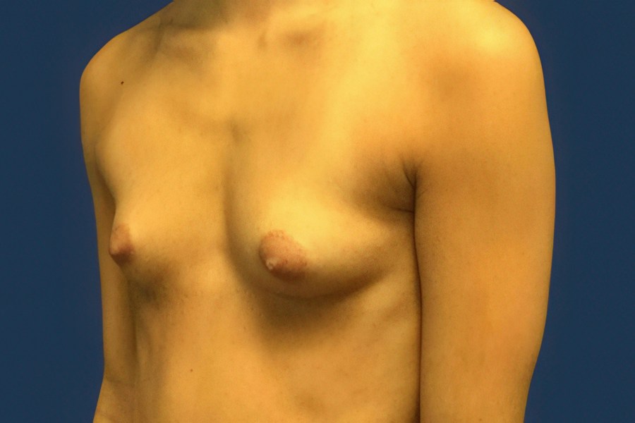 Patient 46677 | Angle View | Before — Dr. Tommaso Addona -