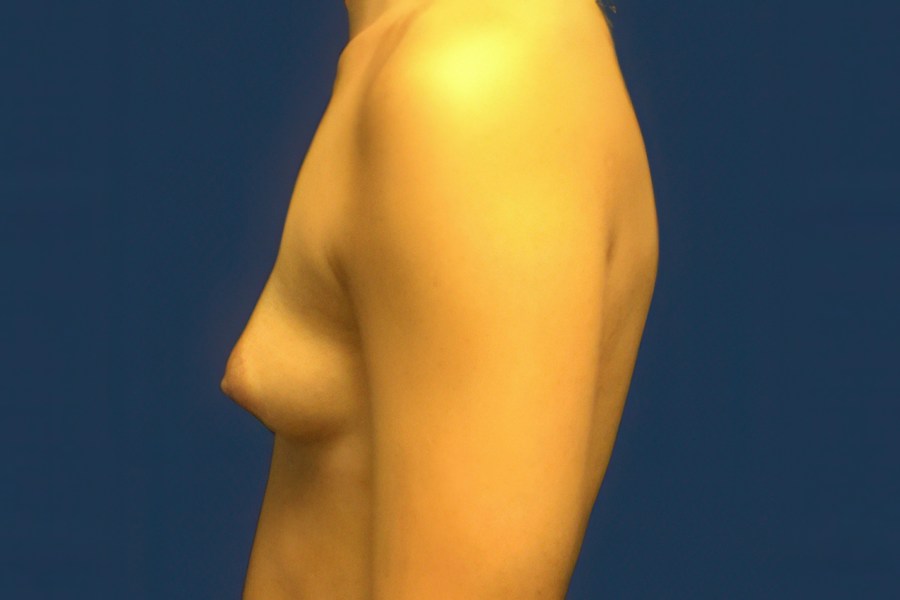 Patient 46677 | Profile View | Before — Dr. Tommaso Addona -