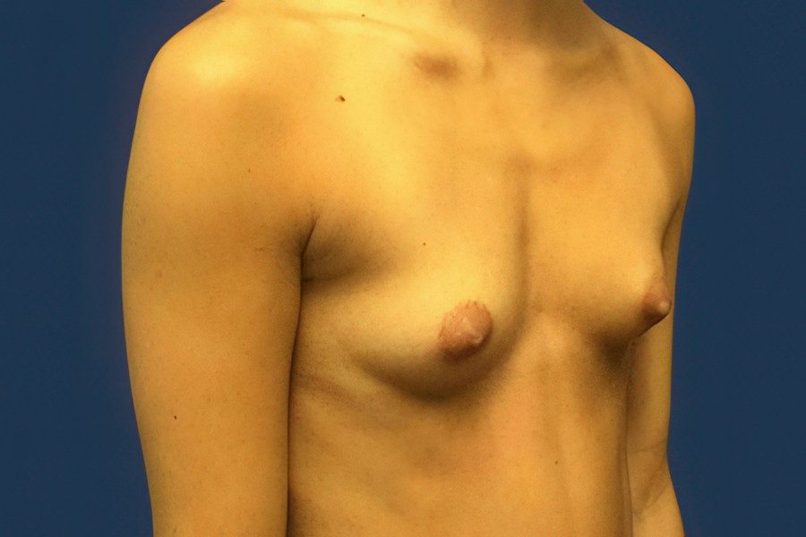 Patient 46677 | Angle View | Before — Dr. Tommaso Addona -