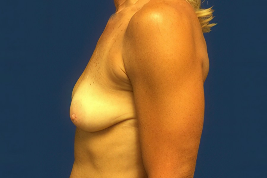 Patient 26976 | Profile View | Before — Dr. Tommaso Addona -