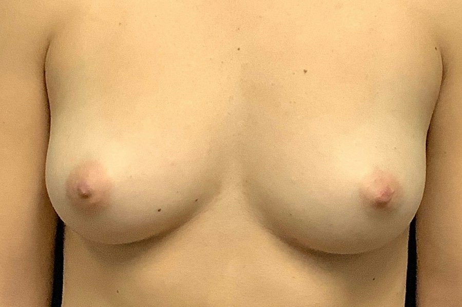 Patient 22817 | Front View | Before — Dr. Tommaso Addona -