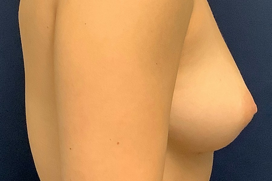 Patient 22817 | Profile View | Before — Dr. Tommaso Addona -