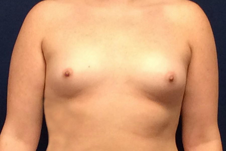 Patient 22822 | Front View | Before — Dr. Tommaso Addona -