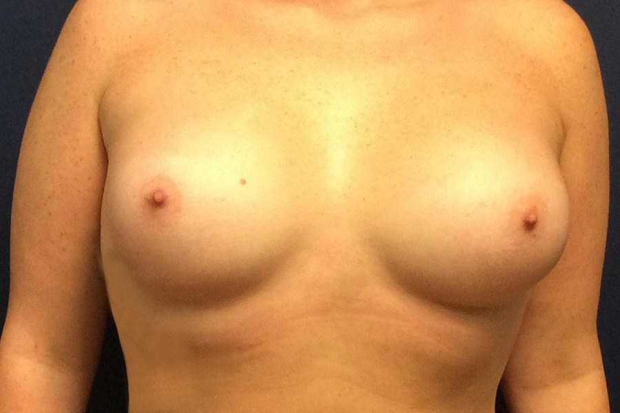 Patient 22822 | Front View | After — Dr. Tommaso Addona -