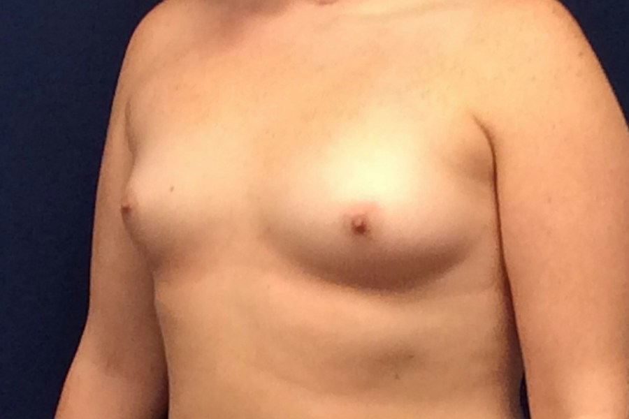Patient 22822 | Angle View | Before — Dr. Tommaso Addona -