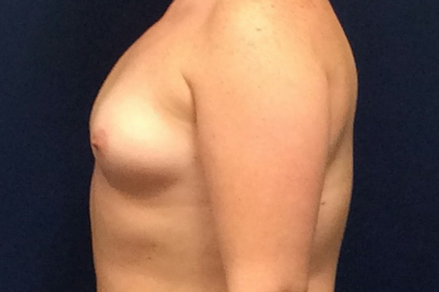 Patient 22822 | Profile View | Before — Dr. Tommaso Addona -