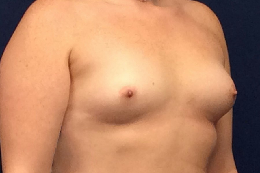 Patient 22822 | Angle View | Before — Dr. Tommaso Addona -
