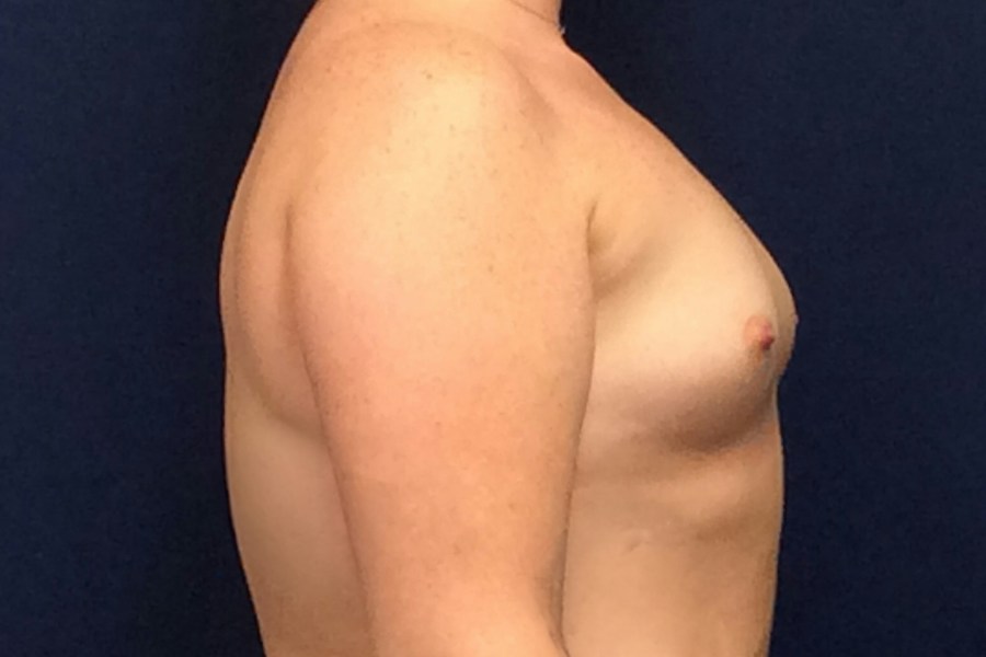 Patient 22822 | Profile View | Before — Dr. Tommaso Addona -