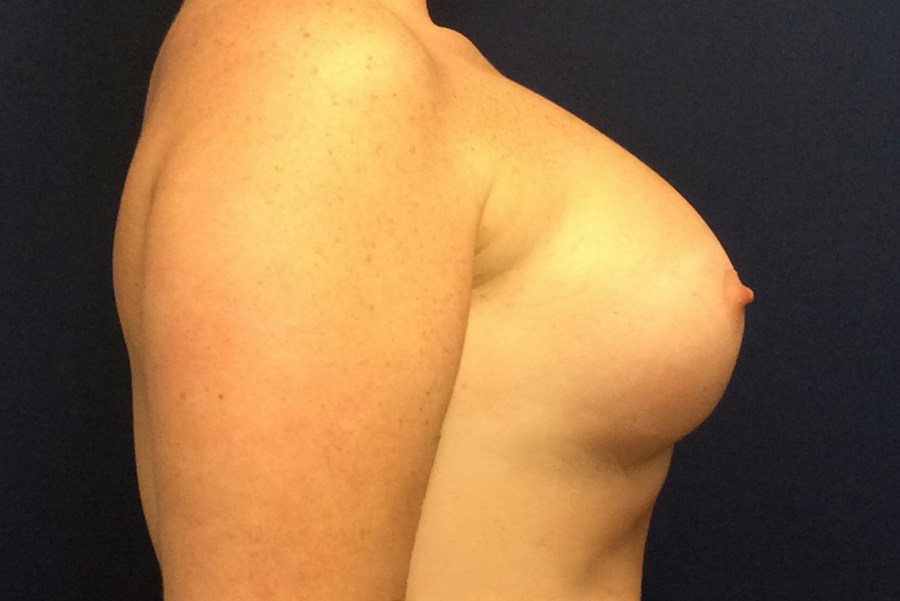 Patient 22822 | Profile View | After — Dr. Tommaso Addona -