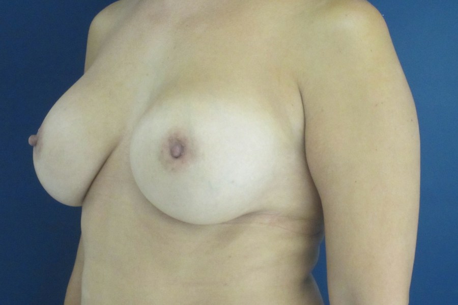 Patient 23648 | Angle View | After — Dr. Tommaso Addona -