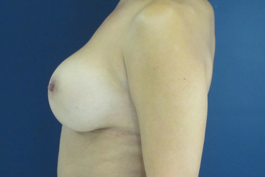 Patient 23648 | Profile View | After — Dr. Tommaso Addona -