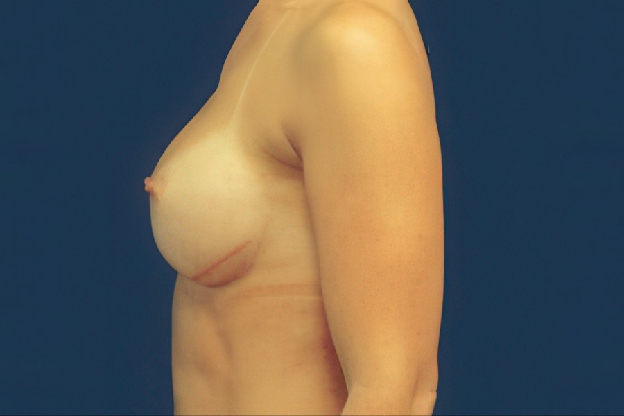 Patient 16291 | Profile View | After — Dr. Tommaso Addona -
