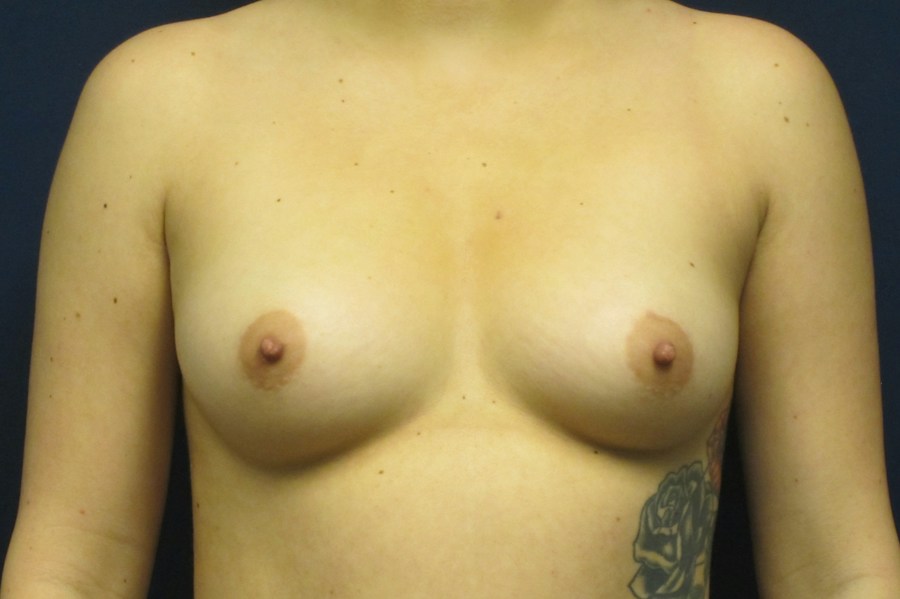 Patient 17777 | Front View | Before — Dr. Tommaso Addona -