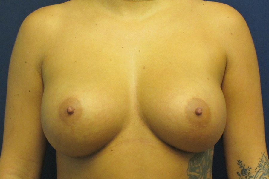 Patient 17777 | Front View | After — Dr. Tommaso Addona -