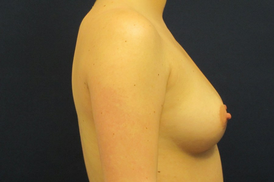 Patient 17777 | Profile View | Before — Dr. Tommaso Addona -