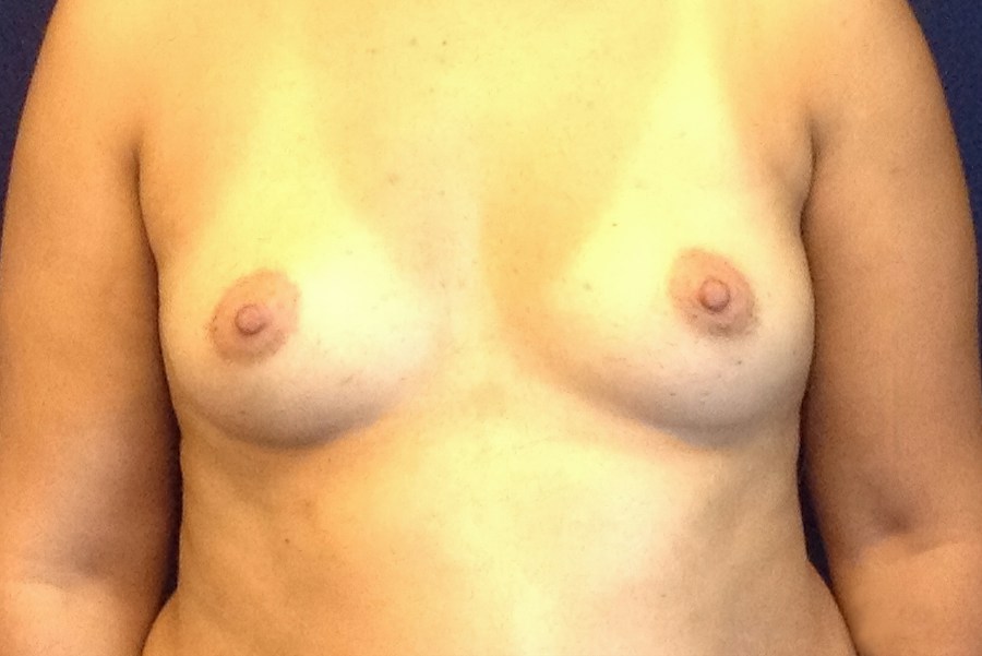 Patient 21795 | Front View | Before — Dr. Tommaso Addona -