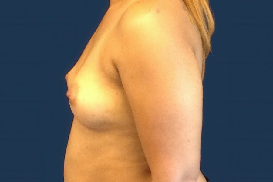 Patient 21795 | Profile View | Before — Dr. Tommaso Addona -
