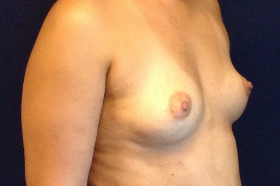Patient 21795 | Angle View | Before — Dr. Tommaso Addona -