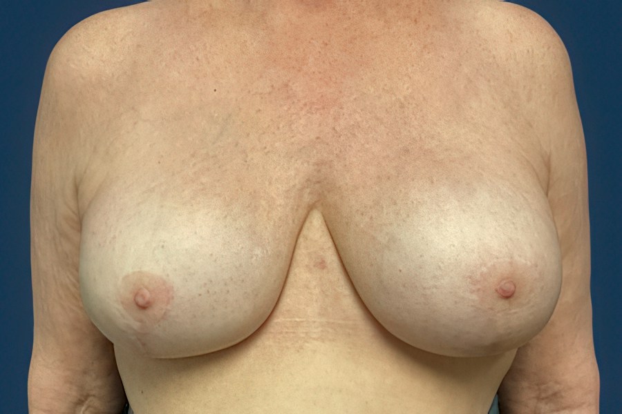 Patient 70557 | Front View | After — Dr. Tommaso Addona -