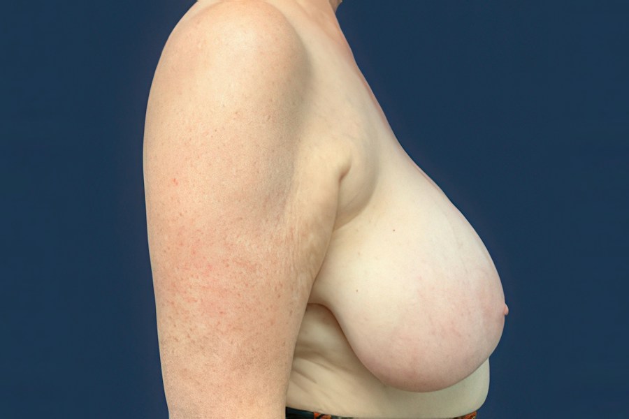 Patient 70557 | Profile View | Before — Dr. Tommaso Addona -