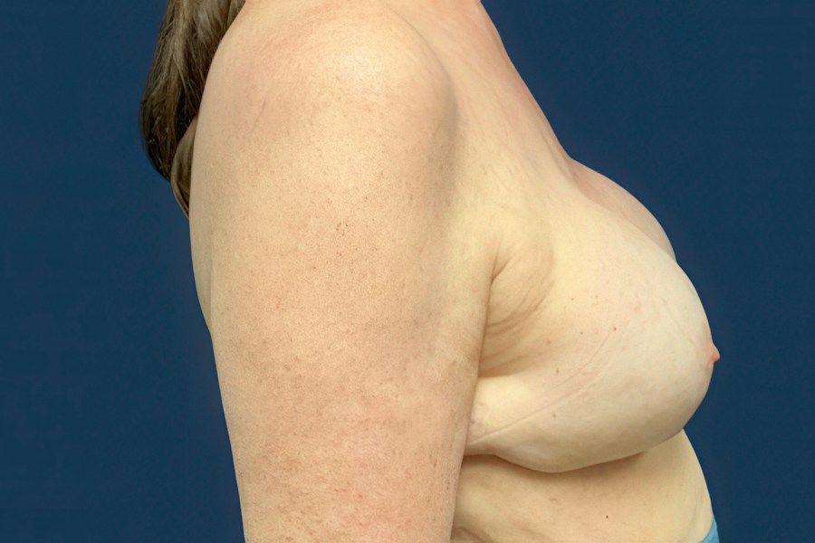 Patient 70557 | Profile View | After — Dr. Tommaso Addona -