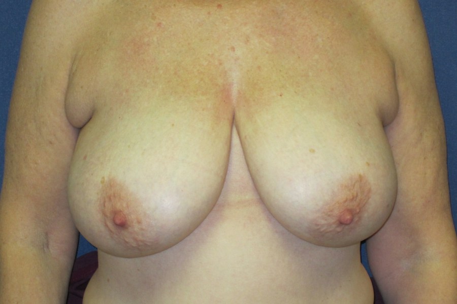 Patient 13599 | Front View | Before — Dr. Tommaso Addona -