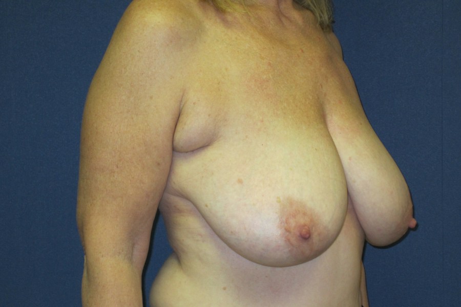 Patient 13599 | Angle View | Before — Dr. Tommaso Addona -