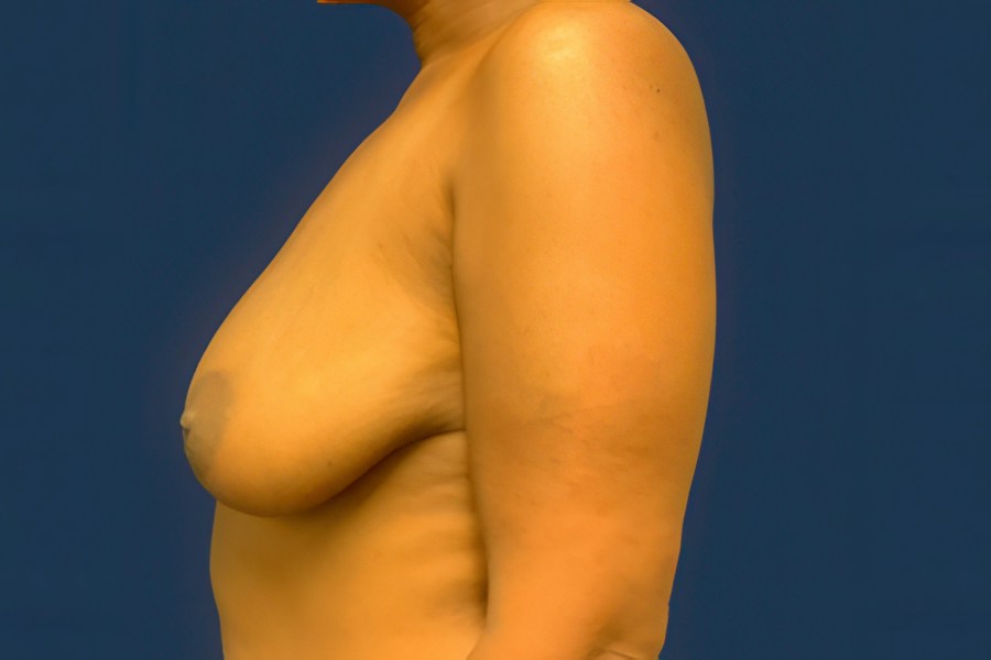 Patient 69278 | Profile View | Before — Dr. Tommaso Addona -