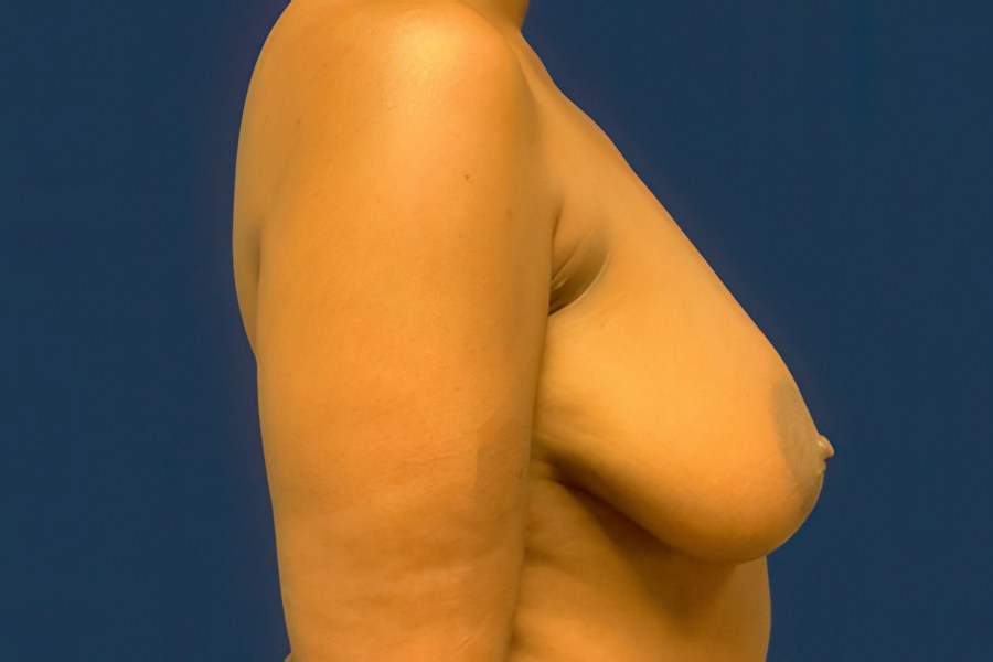 Patient 69278 | Profile View | Before — Dr. Tommaso Addona -