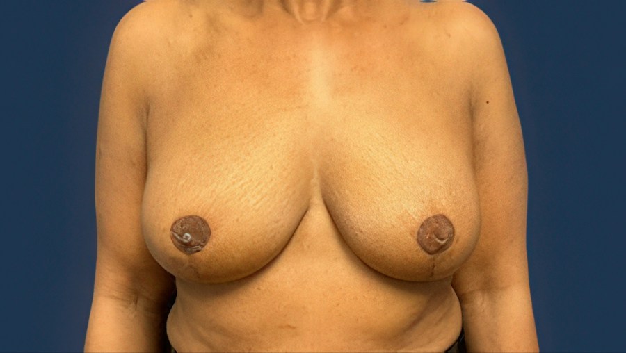 Patient 53101 | Front View | After — Dr. Tommaso Addona -