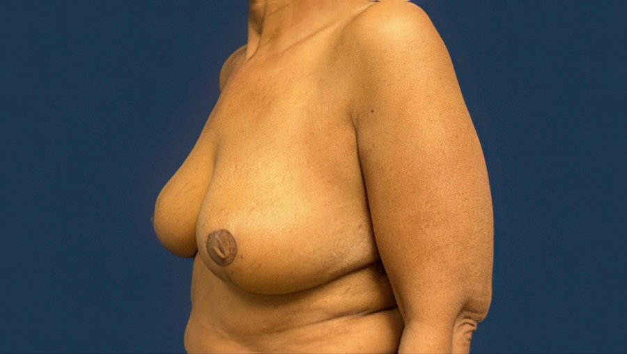 Patient 53101 | Angle View | After — Dr. Tommaso Addona -