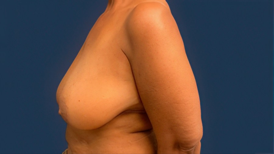Patient 53101 | Profile View | Before — Dr. Tommaso Addona -