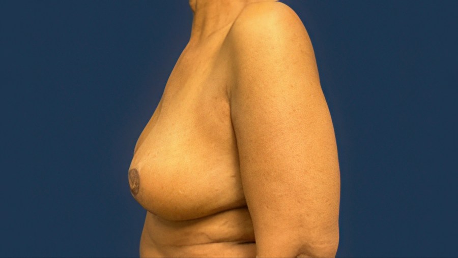Patient 53101 | Profile View | After — Dr. Tommaso Addona -