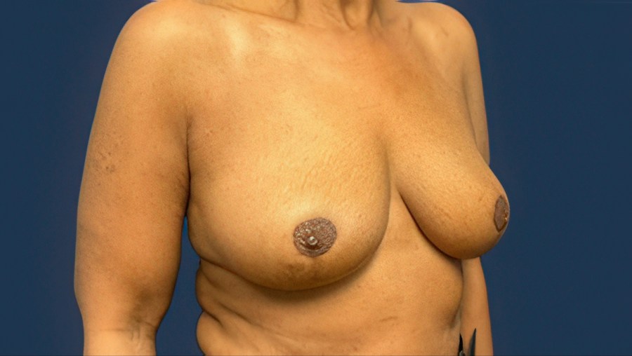 Patient 53101 | Angle View | After — Dr. Tommaso Addona -