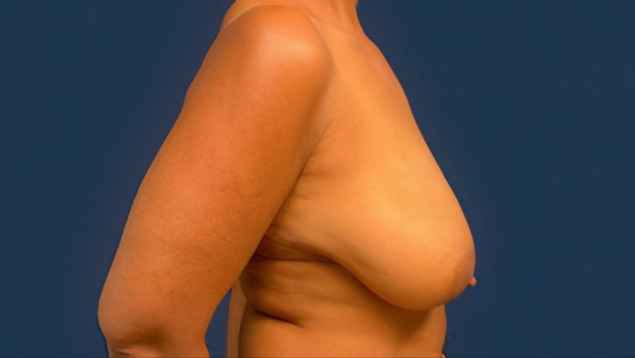 Patient 53101 | Profile View | Before — Dr. Tommaso Addona -