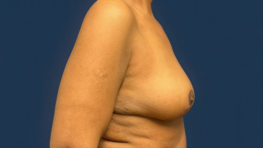 Patient 53101 | Profile View | After — Dr. Tommaso Addona -