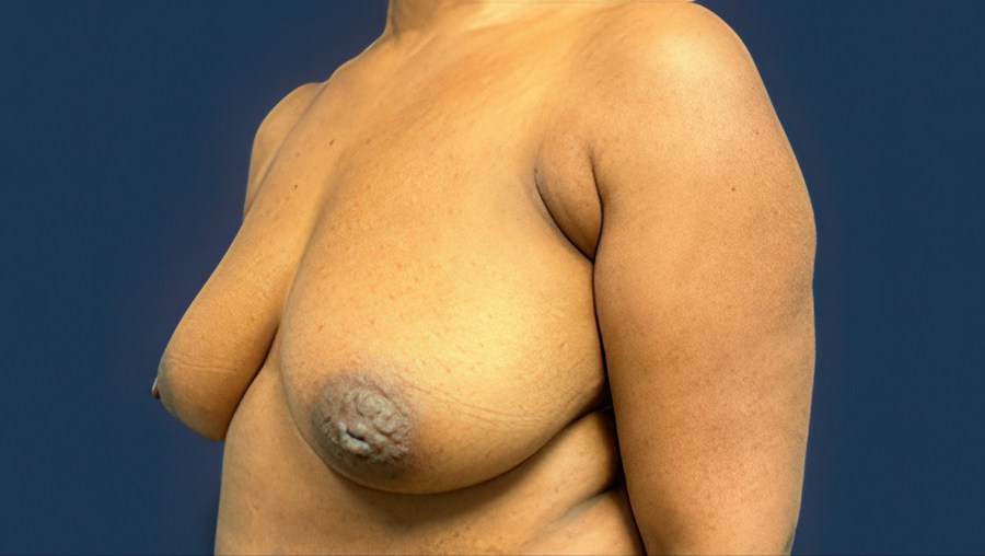 Patient 51686 | Angle View | Before — Dr. Tommaso Addona -