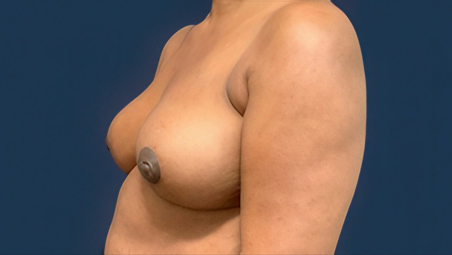 Patient 51686 | Angle View | After — Dr. Tommaso Addona -