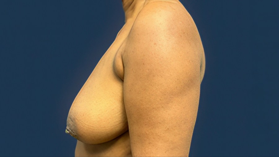 Patient 51686 | Profile View | Before — Dr. Tommaso Addona -