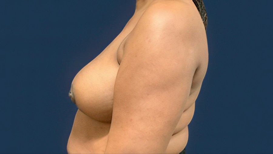 Patient 51686 | Profile View | After — Dr. Tommaso Addona -