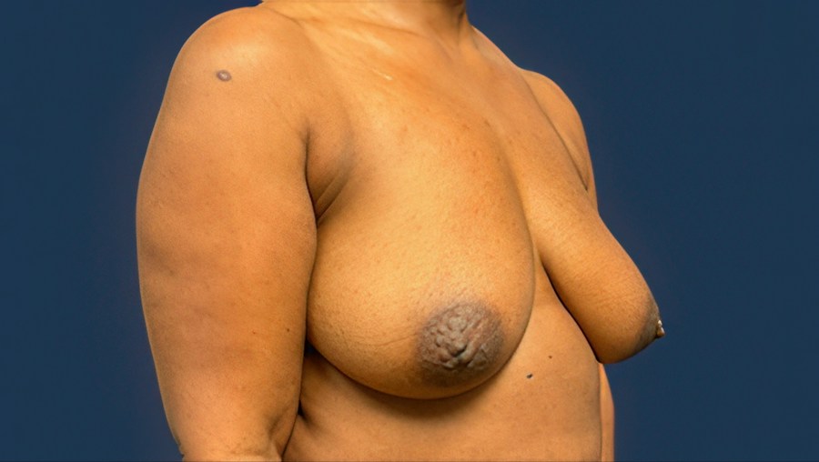 Patient 51686 | Angle View | Before — Dr. Tommaso Addona -