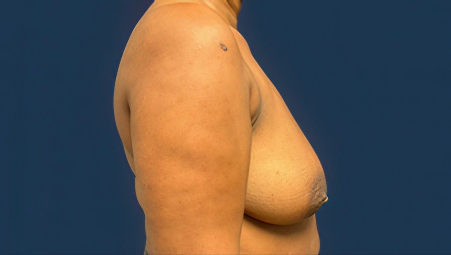 Patient 51686 | Profile View | Before — Dr. Tommaso Addona -