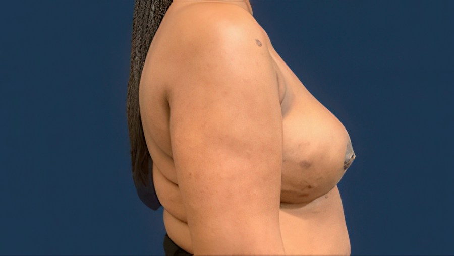 Patient 51686 | Profile View | After — Dr. Tommaso Addona -