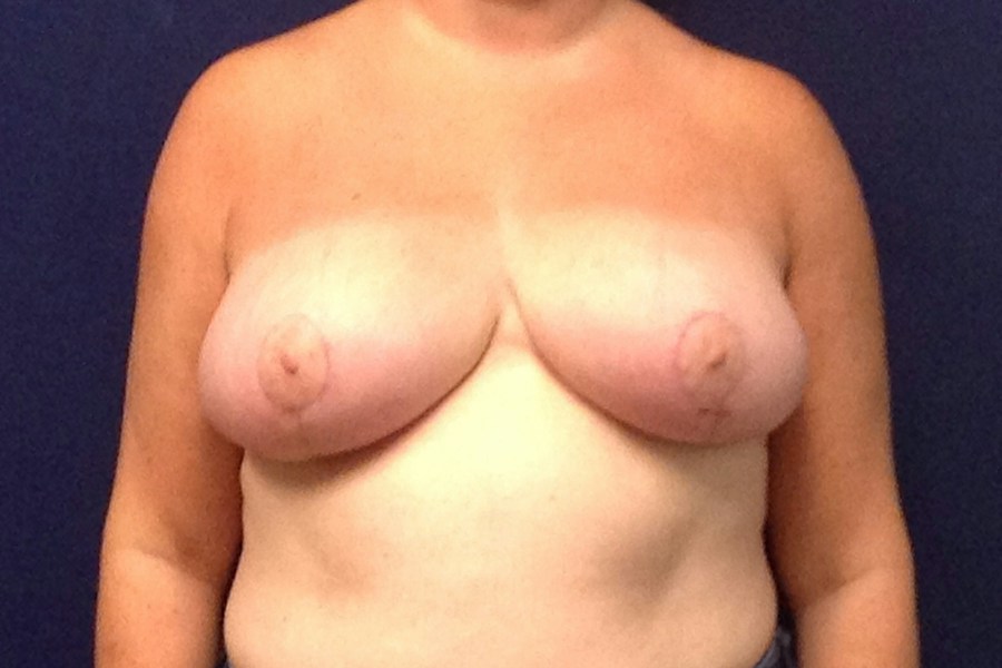 Patient 23320 | Front View | After — Dr. Tommaso Addona -