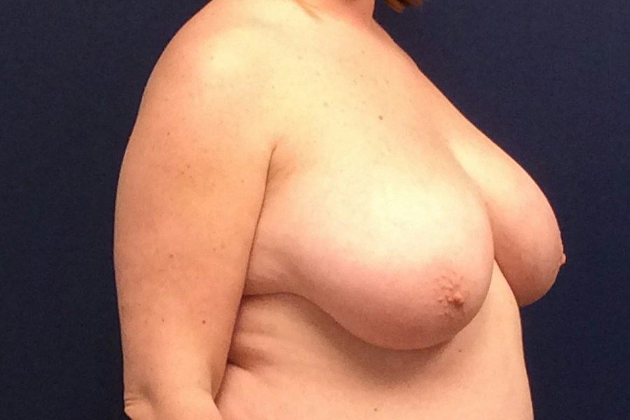 Patient 23320 | Angle View | Before — Dr. Tommaso Addona -